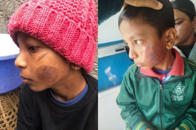 विद्यार्थीले ‘काली’ भनेको आक्रोशमा चार विद्यार्थीको गालामा तातो पन्यूले डाम्ने शिक्षिका पक्राउ